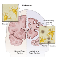 Illustration showing how Alzheimer's disease affects the brain
