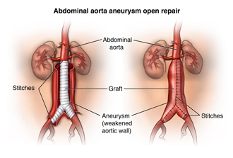 Graft repair of abdominal aneurysm